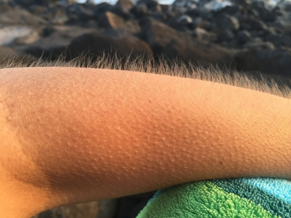 Do you often have goosebumps, even when it's warm?